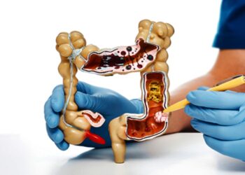 Kolon Kanserinde Erken Teşhis Hayat Kurtarıyor