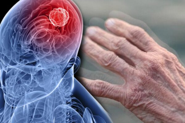 Medipol Sağlık Grubu, Parkinson İçin Yeni Bir Tedavi Uygulamaya Başladı