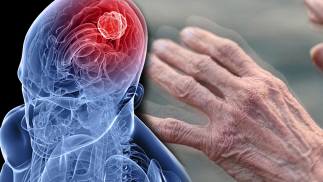 Medipol Sağlık Grubu, Parkinson İçin Yeni Bir Tedavi Uygulamaya Başladı