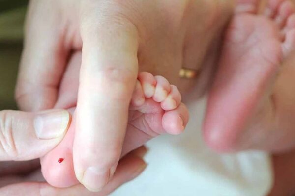 Fenilketonüri Nedir? Belirtileri ve Tedavi Yöntemleri