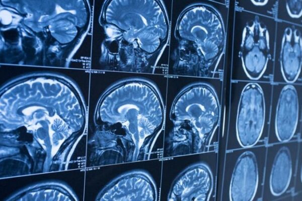 Alzheimer ve Parkinson İçin Erken Teşhiste Çığır Açan Protein Haritası